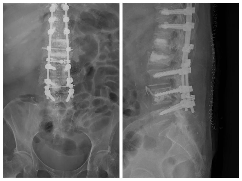 陳劍龍醫師創新3D導航手術讓脊椎傷害患者重生!
